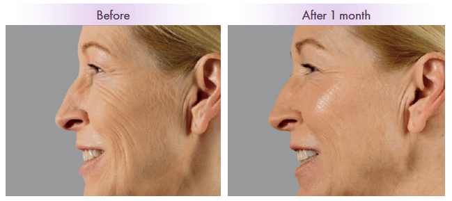 juvederm-voluma-xc-before-and-after-photos-sharon