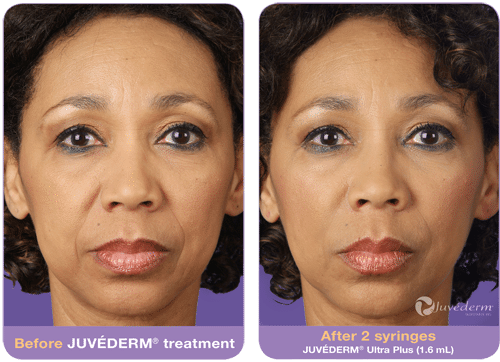 juvederm-before-after-3
