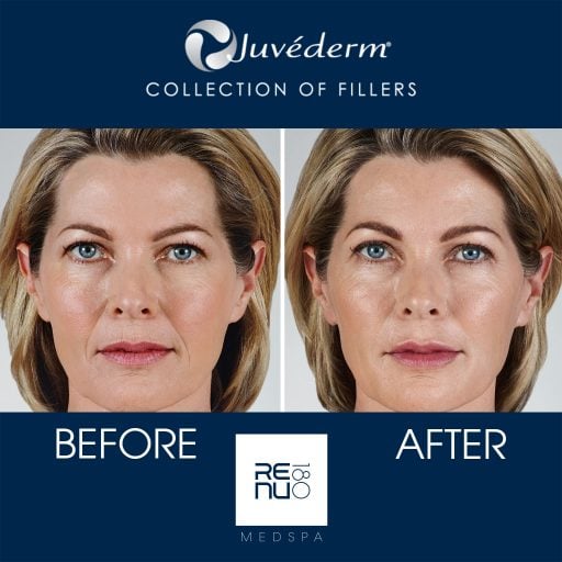 Juvederm Setting In