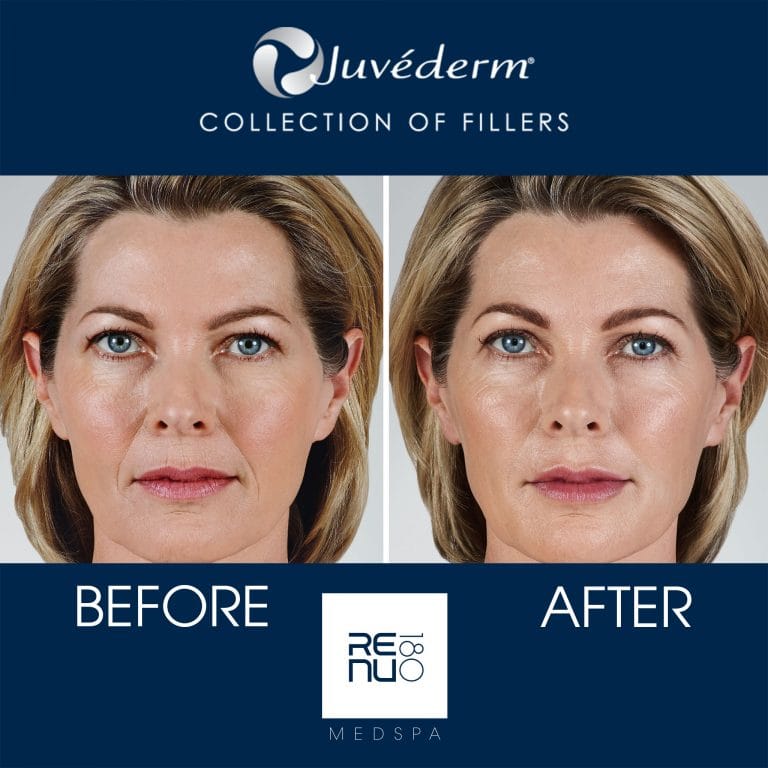 Juvederm Setting In
