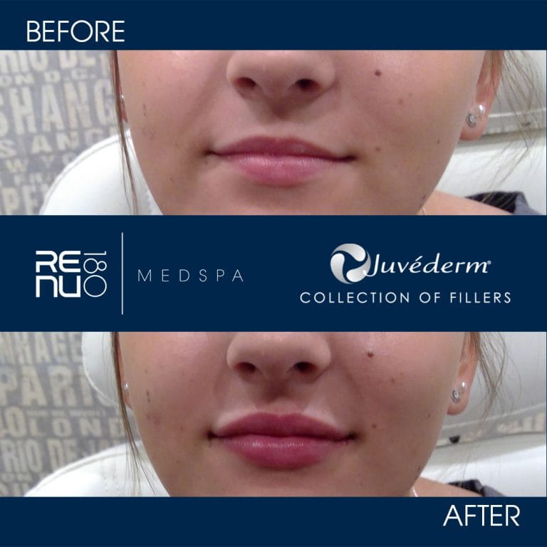 Before and After Juvederm Ultra Use