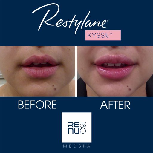 Before and After Lip Injections | Renu 180 Medspa