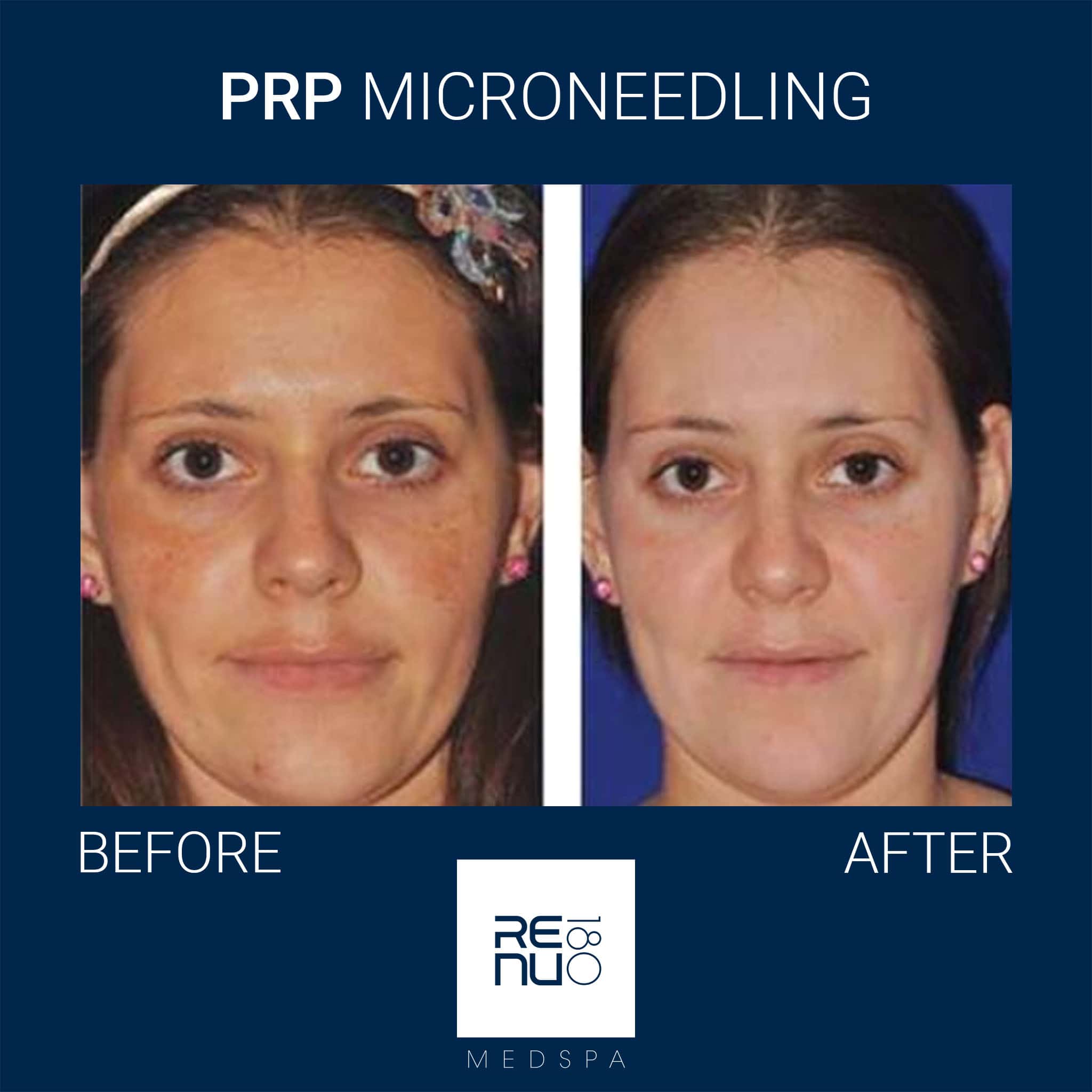 Before And After Gallery Prp Microneedling Renu 180 Medspa