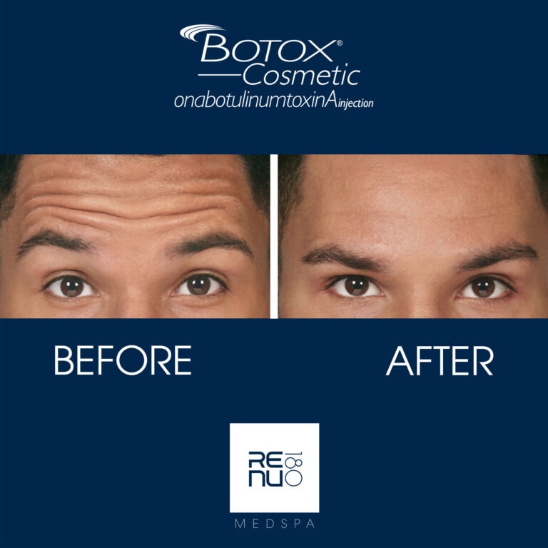 Botox Before & After | Re:nu 180 Medspa
