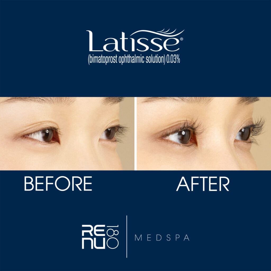 Latisse CT | Latisse Eyelash Growth Serum Before and After | Re:nu 180 Medspa