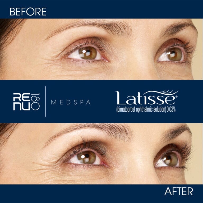 Latisse Eyelash Growth Before and After Photos | Latisse CT | Re:nu 180 Medspa
