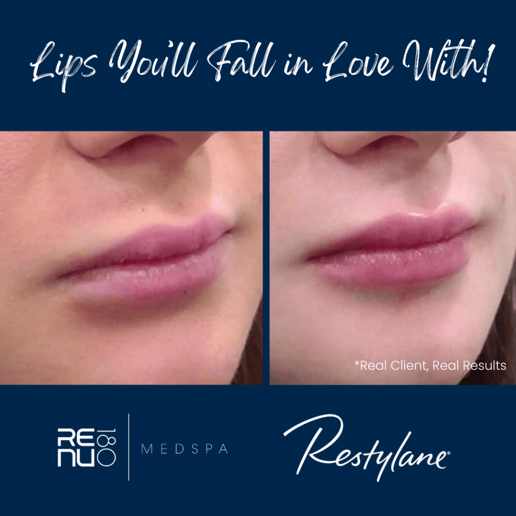 Restylane Lips | Before & After | Re:nu 180 Medspa